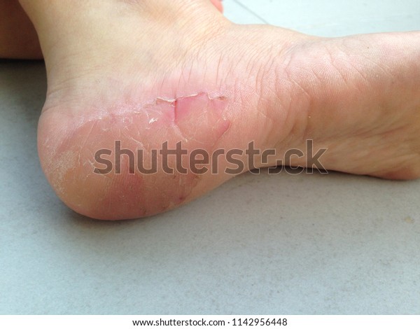 Skin Heels Peel Off Skin Peeling Stock 