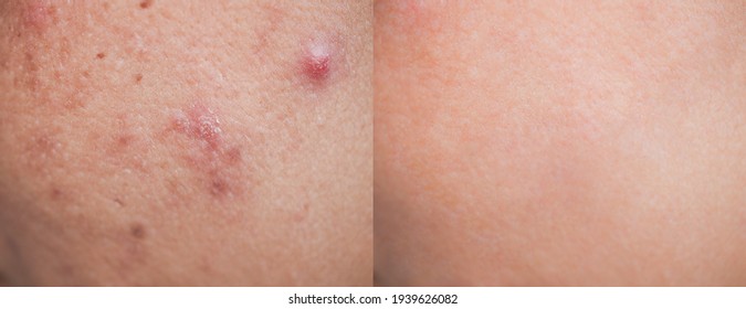 Skin human texture background. Closeup before and after spot red scar acne pimple treatment on skin face asian woman. Problem skincare and beauty concept. 