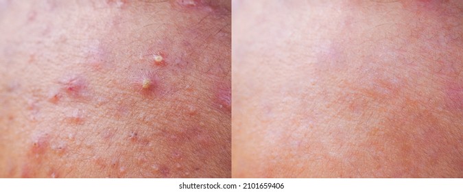 Skin Human Texture Background. Closeup Before And After Spot Red Scar Acne Pimple Treatment On Skin Face Asian Man. Problem Skincare And Health Concept. 