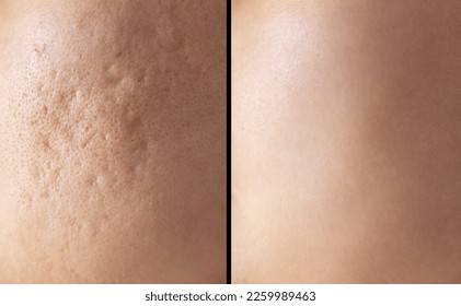 Skin human texture background. Closeup before and after spot red scar acne pimple treatment on skin face asian woman. Problem skincare and beauty concept.