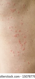 Skin Imperfection Skin Allergy Urticaria Disease Stock Photo Shutterstock