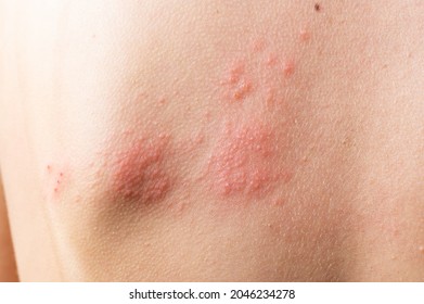 Skin infected Herpes zoster virus. Herpes Virus on body. urticaria rash. atopic dermatitis on body.