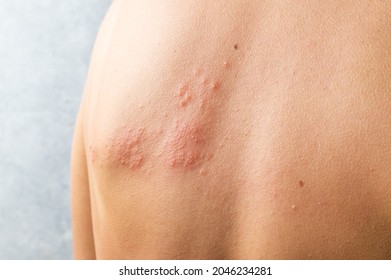 Skin infected Herpes zoster virus. Herpes Virus on body. urticaria rash. atopic dermatitis on body. - Shutterstock ID 2046234281