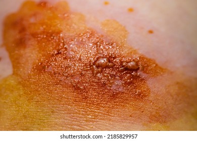 Skin infected Herpes zoster virus