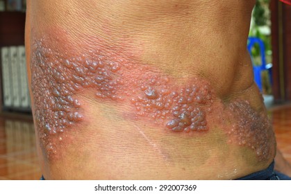 帯状疱疹 の画像 写真素材 ベクター画像 Shutterstock