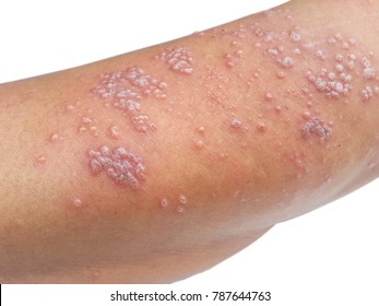 Skin infected Herpes zoster virus on the arms