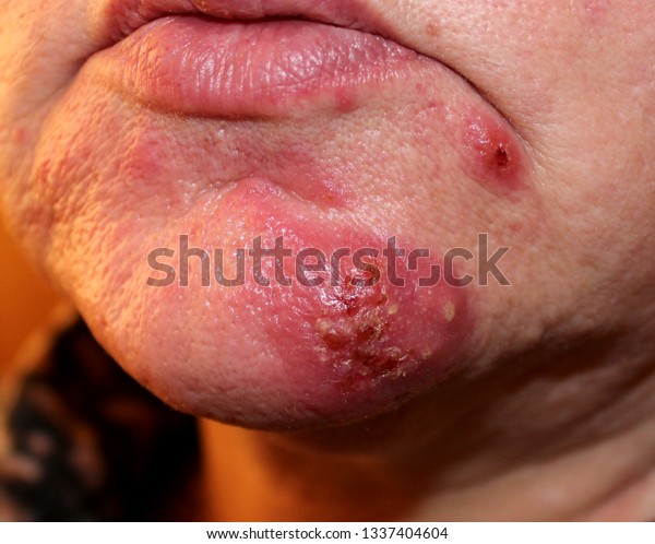 skin-infection-bacterial-folliculitis-female-rosacea-stock-photo-edit