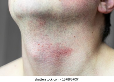 Skin Irritation On Male Neck After Shaving. Close-up Photo.