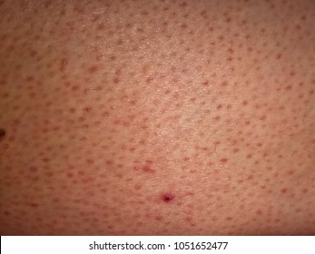 Skin With Keratosis Pilaris. 