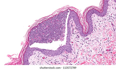 Pemphigus Images Stock Photos Vectors Shutterstock