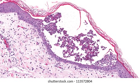 Pemphigus Images Stock Photos Vectors Shutterstock