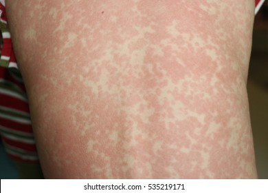 Skin Lesion Of Measles As Maculopapular Rash With Confluent Becomes Patches Leave Normal Skin White Area, Focal Focus On The Mid Back