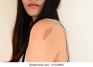 Skin Lesions From Allergies, Skin Women.