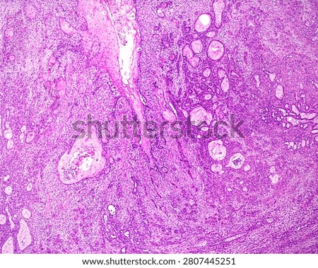 Skin. The light microscope micrograph of a poorly differentiated squamous cell carcinoma (epidermoid carcinoma) showing minimal keratinization, nuclear atypia and infiltration of the dermis.