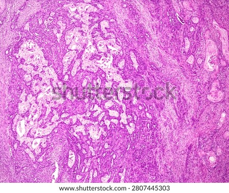 Skin. The light microscope micrograph of a poorly differentiated squamous cell carcinoma (epidermoid carcinoma) showing minimal keratinization, nuclear atypia and infiltration of the dermis.