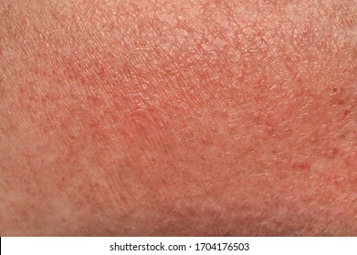 Photodermatitis Images, Stock Photos & Vectors | Shutterstock