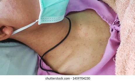 Skin Of Measles Patient, Rubella Infection People, Skin Clinical Sign, Rash With Fever Patient