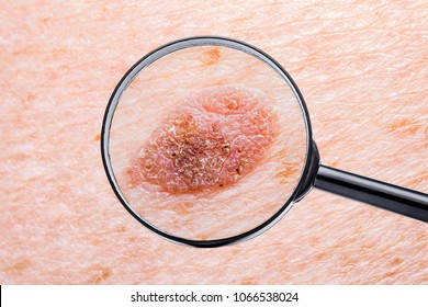 Skin Mole Defect High Magnification Macro Photo For Medical Diagnosis