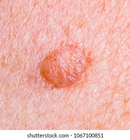 Skin Mole Defect High Magnification Macro Stock Photo 1067100851 ...