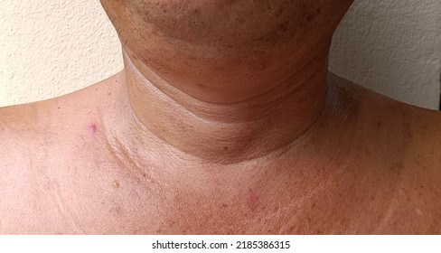 Skin, Neck, Chest,men Have Wrinkles, Sunburn, Freckles,dark Spots,red Rashes.