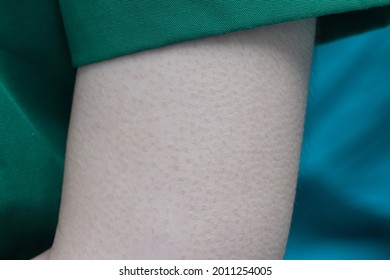 Skin On The Arm There Was A Noticeable Goosebumps.                               