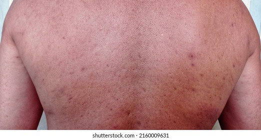 The Skin On The Back Of Men Is Acne, Wrinkles.