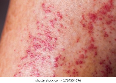 The skin on the legs is inflamed and red.