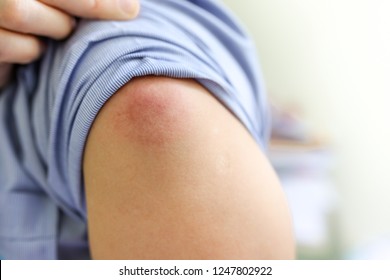 Skin Of Patient After Receive Tetanus Vaccine , Adverse Events Following Immunization, Cellulitis
