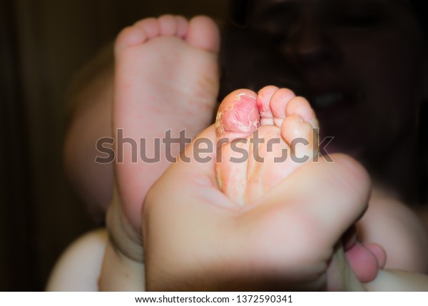 Skin Peeled Off Toddlers Skin After Stock Photo Edit Now