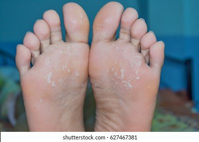 Skin Peeling Off From Under Foot