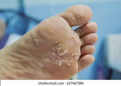 flaky skin on bottom of feet