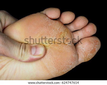 Skin peeling off from under foot, examined by podiatrist, at closeup towards black