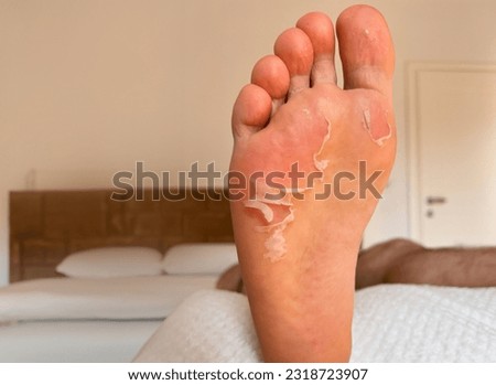 skin peels off a foot. sweaty athlete foot skin peeling.  dermatitis, dry skin, fungal infection, eczema and dehydration. close-up of peeling and cracked foot.