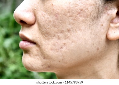 Skin Problem With Acne Diseases, Close Up Woman Face With Whitehead Pimples, Menstruation Breakout, Scar And Oily Greasy Face, Beauty Concept.