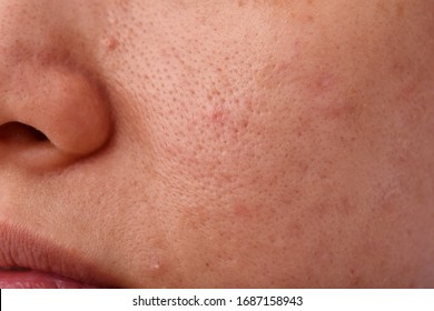 Skin Problem With Acne Diseases, Close Up Woman Face With Dry Lip Mouth, Scar And Oily Greasy Face, Beauty Concept.