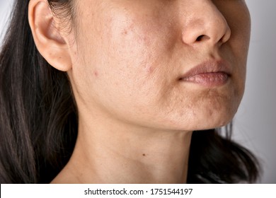 Skin Problem With Acne Diseases, Close Up Of Asian Woman Face With Whitehead Pimples, Menstruation Breakout, Scar And Oily Greasy Face, Beauty Concept.