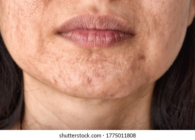 Skin Problem With Acne Diseases, Close Up Woman Face With Whitehead Pimples On Chin, Menstruation Breakout, Scar And Oily Greasy Face, Beauty Concept.