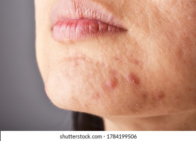 Skin Problem With Acne Diseases, Close Up Woman Face With Whitehead Pimples On Chin, Menstruation Breakout, Scar And Oily Greasy Face.