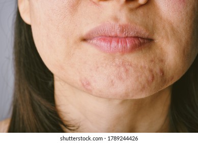 Skin Problem With Acne Diseases, Close Up Woman Face With Whitehead Pimples On Chin, Menstruation Breakout, Scar And Oily Greasy Face, Beauty Concept.