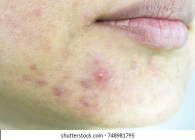 Skin Problem With Acne Diseases, Close Up Woman Face With Whitehead Pimples On Chin, Menstruation Breakout, Scar And Oily Greasy Face, Beauty Concept.