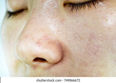 Skin Problem With Acne Diseases, Close Up Woman Face With Whitehead Pimples On Nose, Scar And Oily Greasy Face, Beauty Concept.