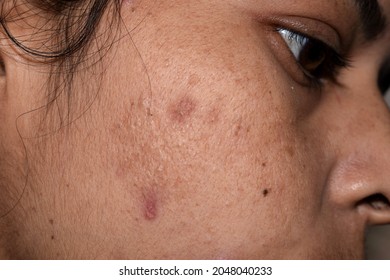 Skin Problem With Acne Scars, Close Up Woman Face