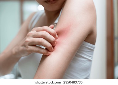 skin problem and beauty. Young woman scratch body has itchy skin from skin allergic, steroid allergy, sensitive skin, red from sunburn, chemical allergy, rash, insect bites, Seborrheic Dermatitis. - Shutterstock ID 2350483735