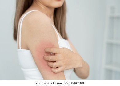 skin problem and beauty. Young woman scratch body has itchy skin from skin allergic, steroid allergy, sensitive skin, red from sunburn, chemical allergy, rash, insect bites, Seborrheic Dermatitis. - Shutterstock ID 2351380189