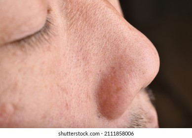 Skin Problem With Wrinkle And Pigmentation, Close Up Men Face With Acne And Dry Skin, Large Pore And Oily Greasy Face, Beauty Concept.