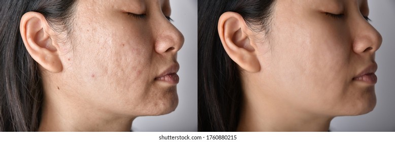 Skin Problems And Acne Scar, Before And After Acne Facial Care Treatment, Beauty Concept.