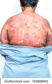 Skin of Psoriasis patient.Psoriasis is an autoimmune disease that affects the skin cause skin inflammation red and scaly.