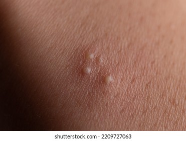 Skin Rash And Blisters On Body,inflamed Zit On Skin.