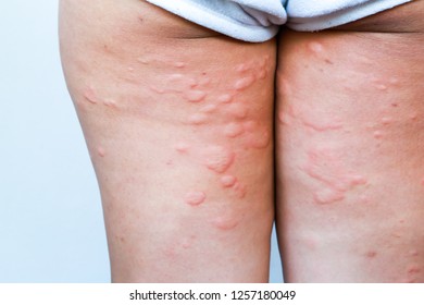 Skin rash in the legs