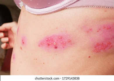 skin rash treatment on woman body. Shingles, Disease, Herpes zoster, varicella-zoster virus. skin rash and blisters on body